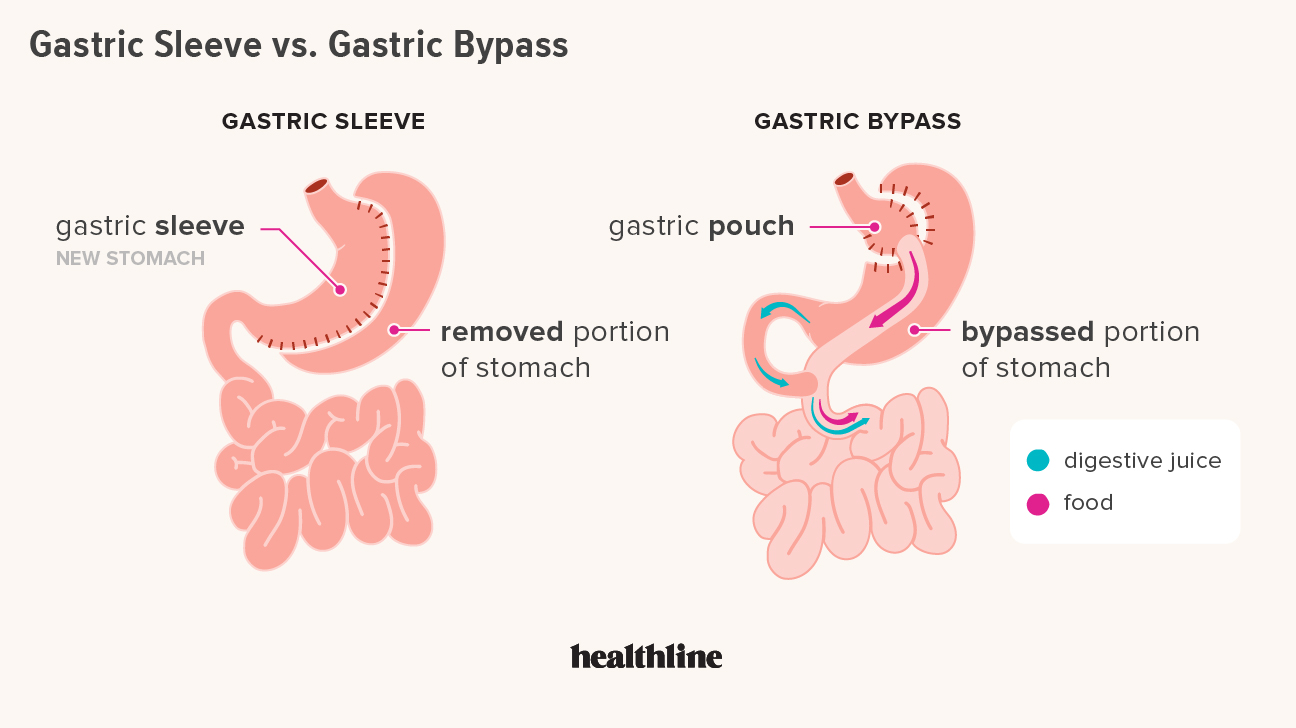 4 Crucial Steps for a Successful Roux-en-Y Gastric Bypass Operation