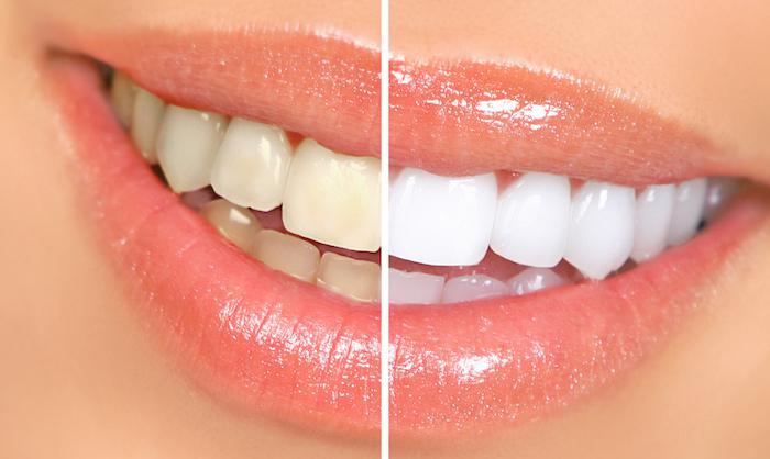 Essential Things to Know About Teeth Whitening